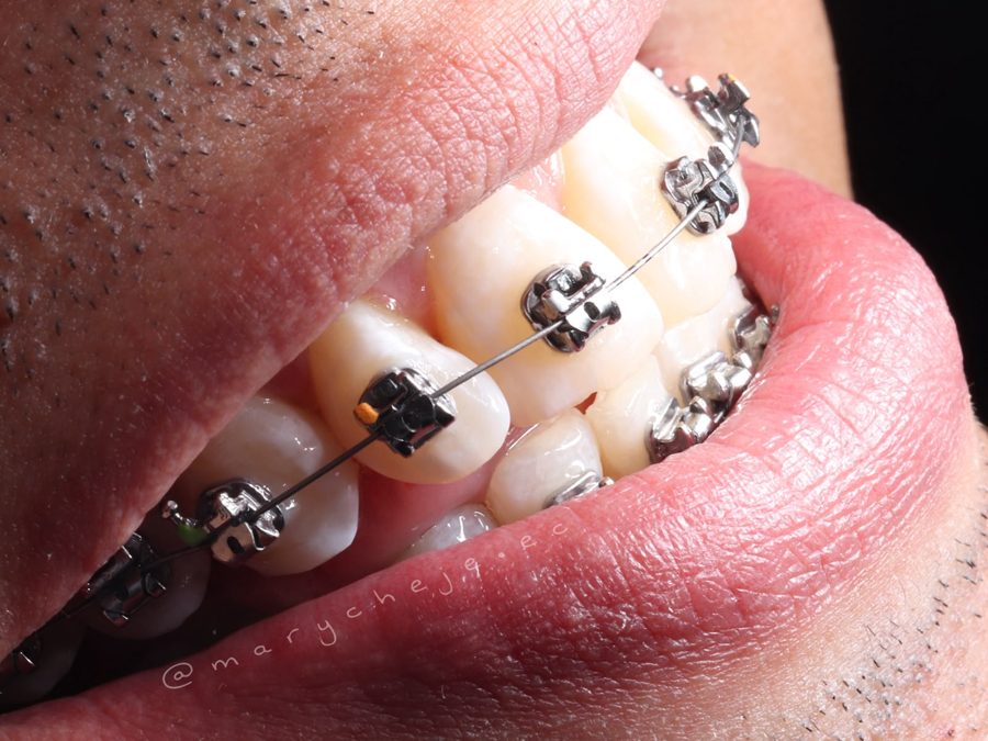 Brackets autoligados metálicos, vista lateral