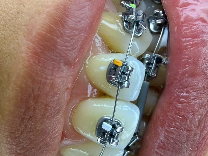 Brackets autoligados metálicos instalados