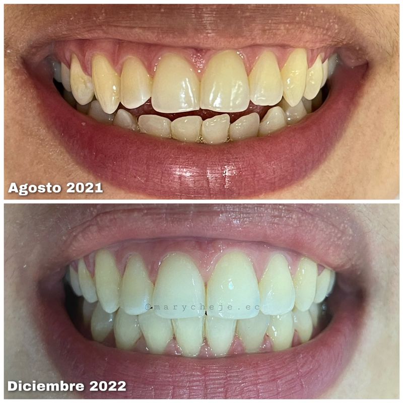 Sonrisa antes y después: agosto de 2021 y diciembre de 2022