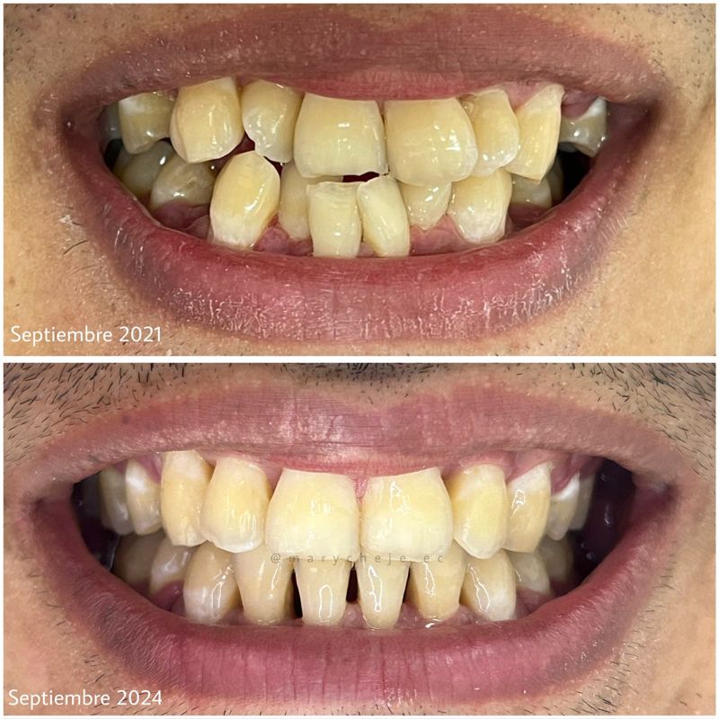 Sonrisa antes y después: septiembre de 2021 y septiembre de 2024