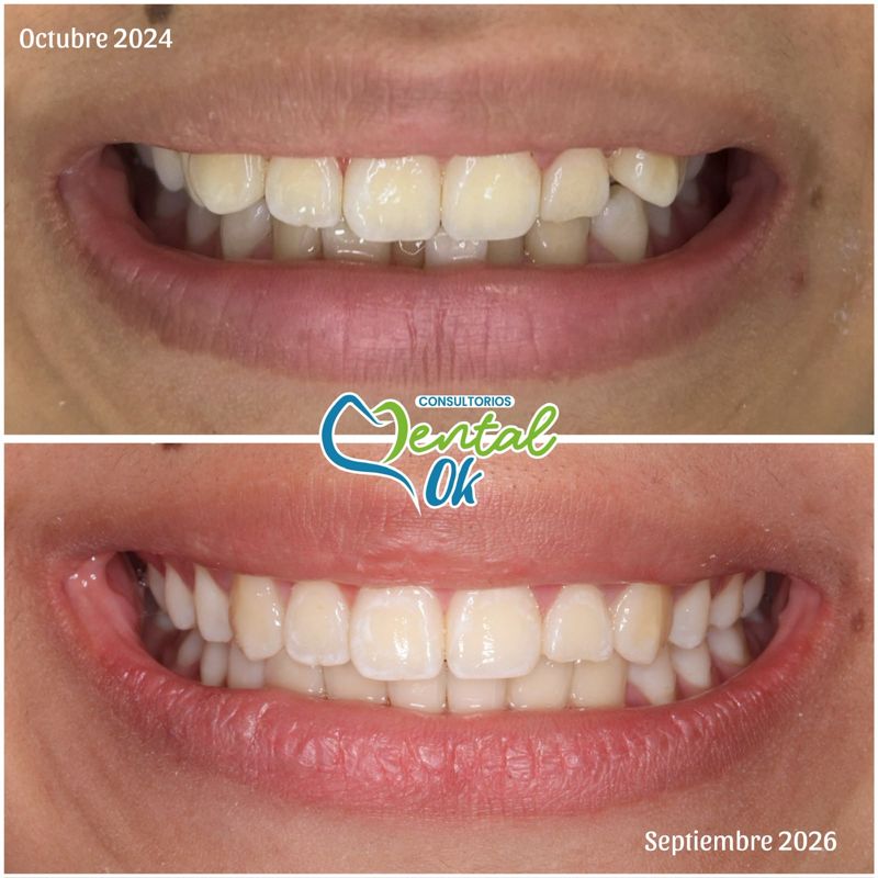 Sonrisa antes y después: octubre de 2024 y septiembre de 2026