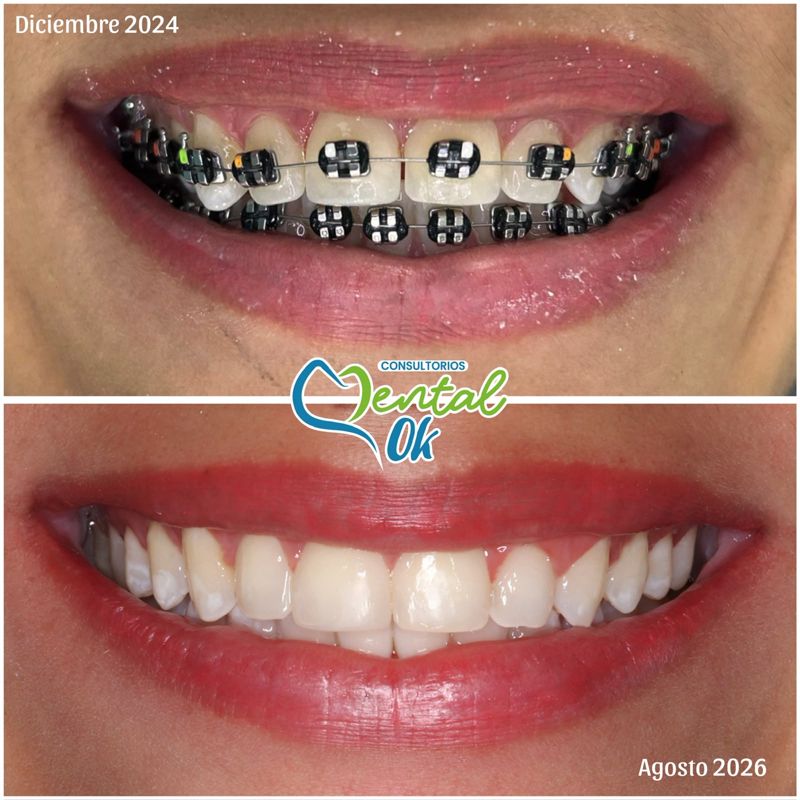Sonrisa: diciembre de 2024 con brackets y agosto de 2026 al terminar
