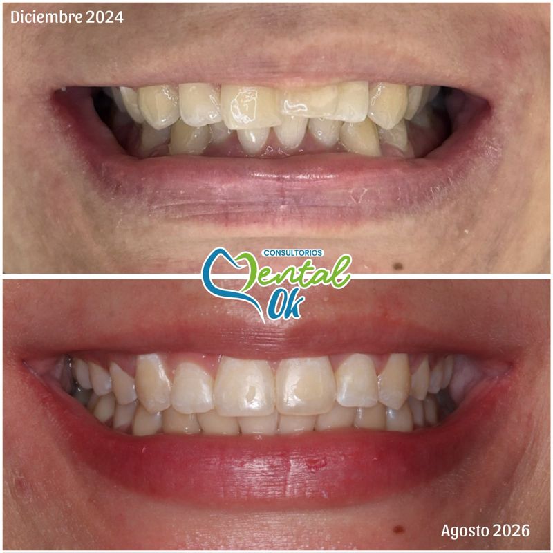 Sonrisa antes y después: diciembre de 2024 y agosto de 2026