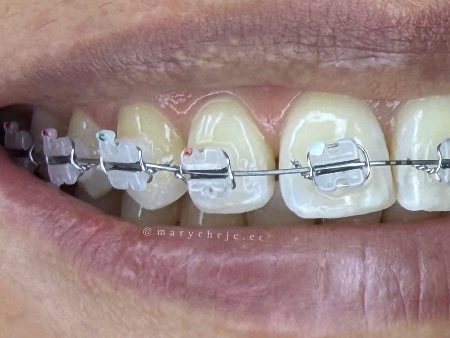 Brackets cerámicos en la sonrisa, vista lateral