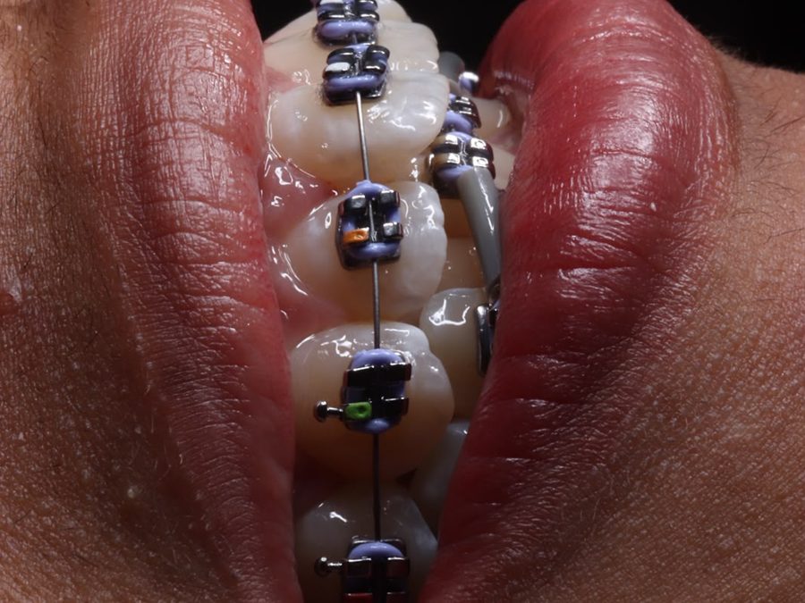 Brackets metálicos, vista de cerca