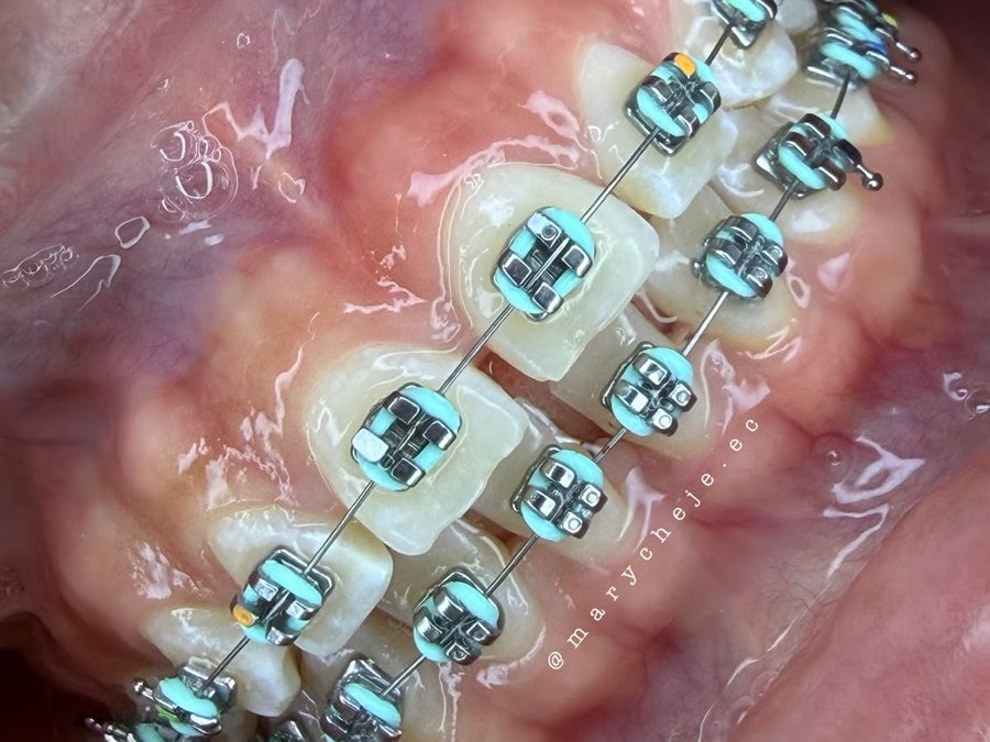 Brackets metálicos con ligas color menta