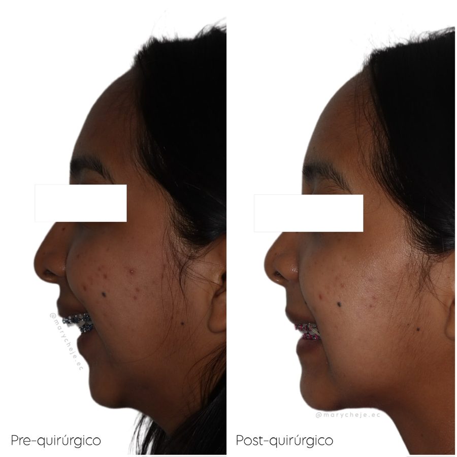 Perfil facial sonriendo antes y después de la cirugía, con los ojos cubiertos