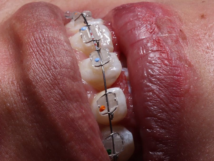 Brackets de zafiro, vista lateral